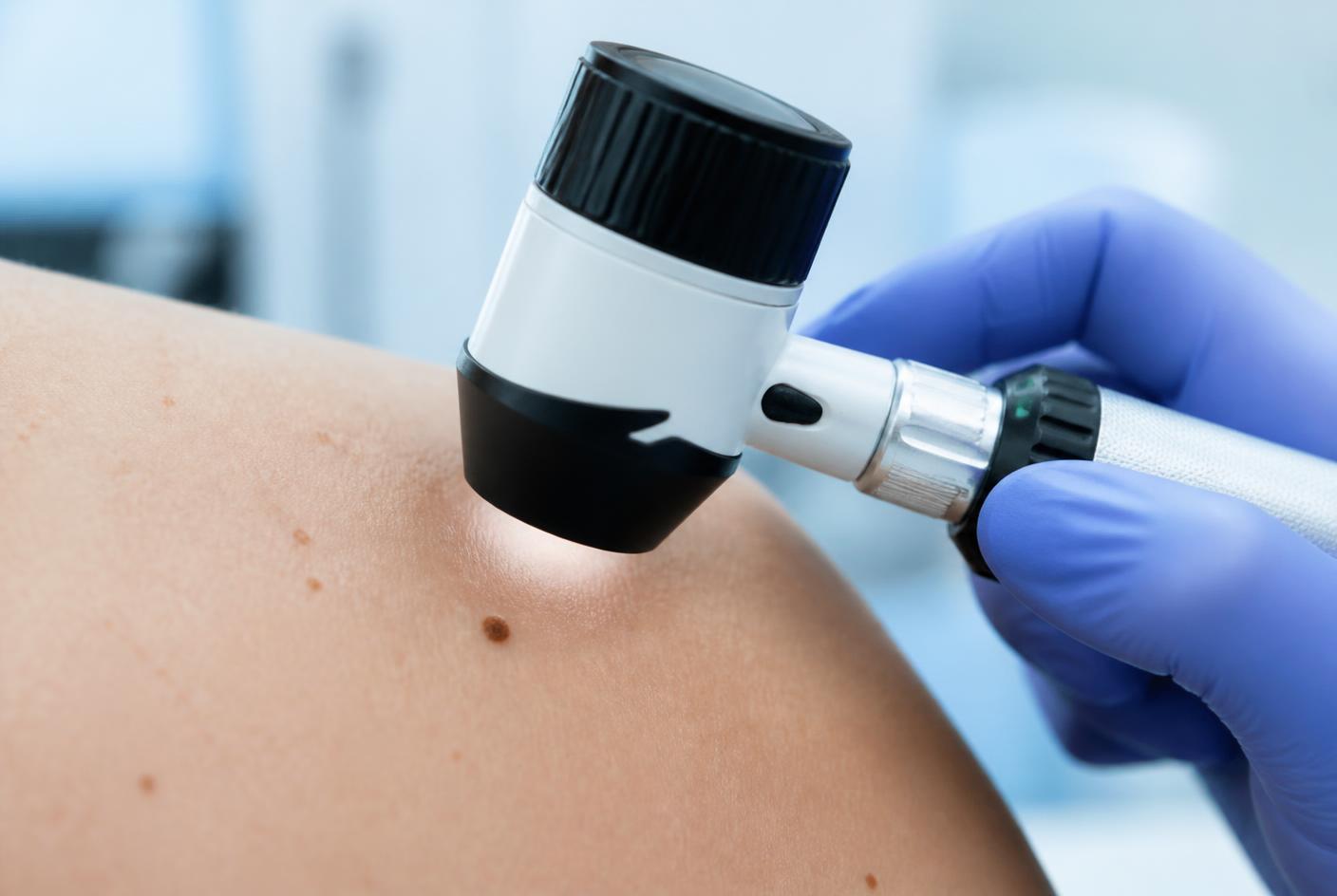 Untersuchung eines Muttermals mit einem Dermatoskop